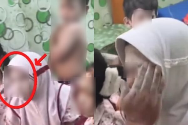 Penanganan siswa SD di Madura yang mengeluh gatal-gatal usai makan MBG, dengan bedak pereda gatal.